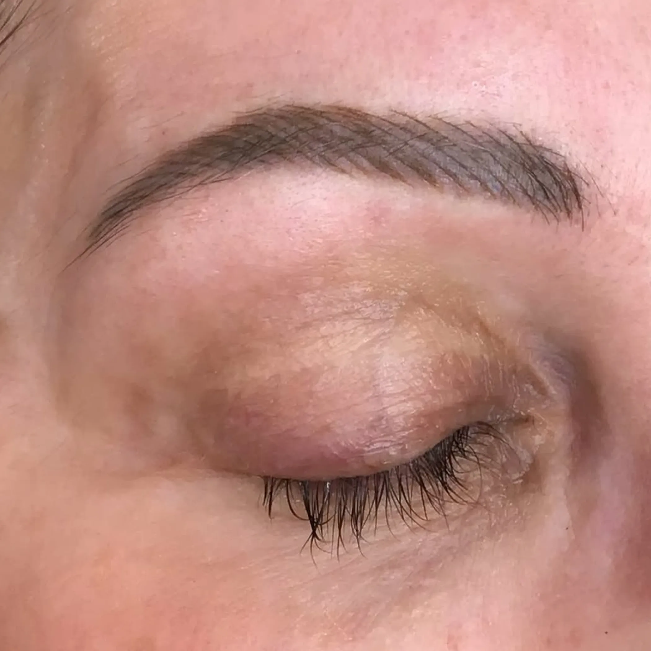 pigment migration on skin near eyebrow